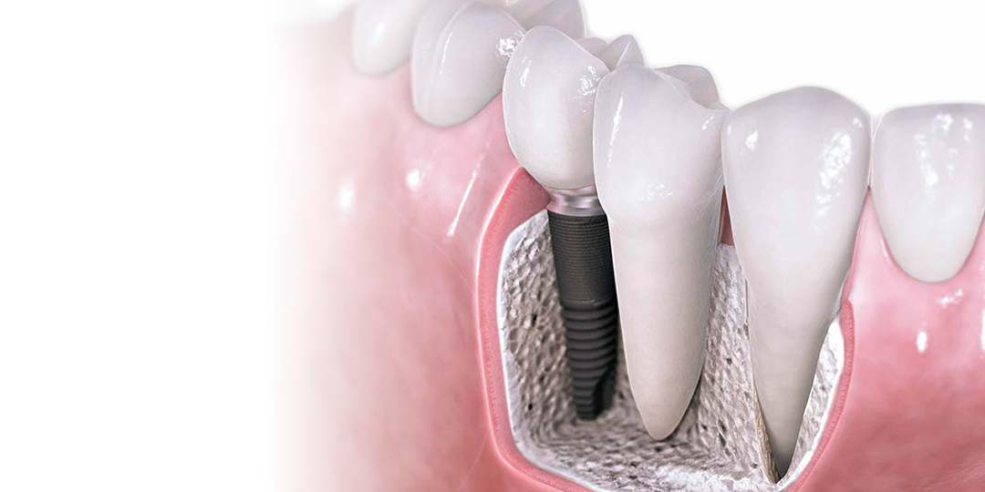 Policlínica R&C - Odontología intergal - Implantología